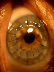 Trasplante de córnea