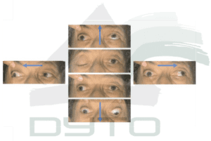 Fig 1. Parálisis III nc derecho. En las fotos centrales se observa el párpado del ojo derecho totalmente cerrado y al levantarlo con el dedo el ojo derecho esta desviado hacia fuera. Siguiendo los movimientos de las flechas se observa como el ojo derecho no se mueve hacia adentro, hacia arriba ni hacia abajo.