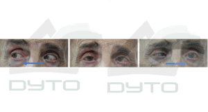 Fig 2 Parálisis del VI nc izquierdo. En la foto central se observa el ojo izquierdo desviado hacia adentro y siguiendo el movimiento de las flechas se observa como el ojo izquierdo no se mueve hacia fuera.