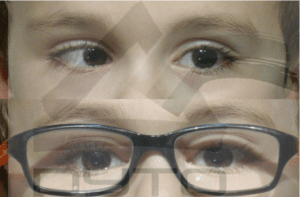Hipermetropía que produce un estrabismo. Cuando lleva las gafas se corrige el estrabismo