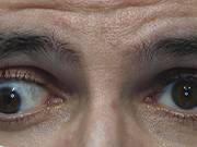 Estrabismo Dr. Blasco