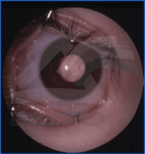 Fig 2. En ocasiones solo se ve ese reflejo cuando el niño mira hacia un lado o incluso en fotografías que llaman la atención a los padres porque ven las dos pupilas de color diferente