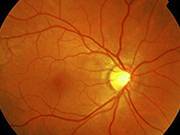 Retinografía digital Retinografía digital